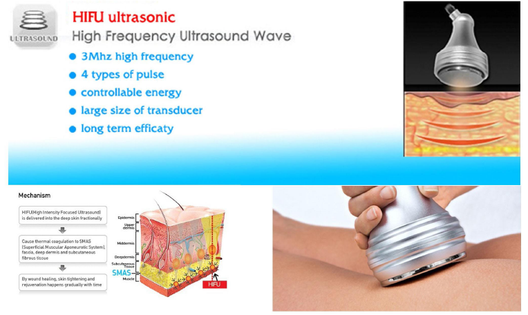 Aplicación Corporal del Sistema HIFU (High-Intensity Focused Ultrasound)  Ultrasonido focalizado de alta intensidad