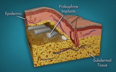 Probuphine  –  Un implante para luchar contra la adicción de opiáceos