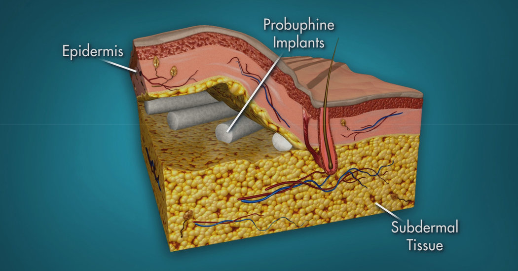 Probuphine  –  Un implante para luchar contra la adicción de opiáceos