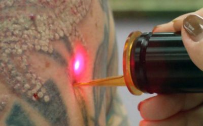 Tratamiento selectivo de los tatuajes con láser de ND:YAG Q-Switched (Borrar / eliminar Tatoo)