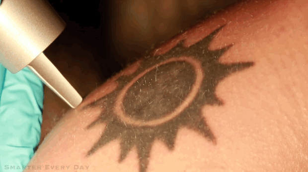 ¿Será posible borrar el tatuaje?