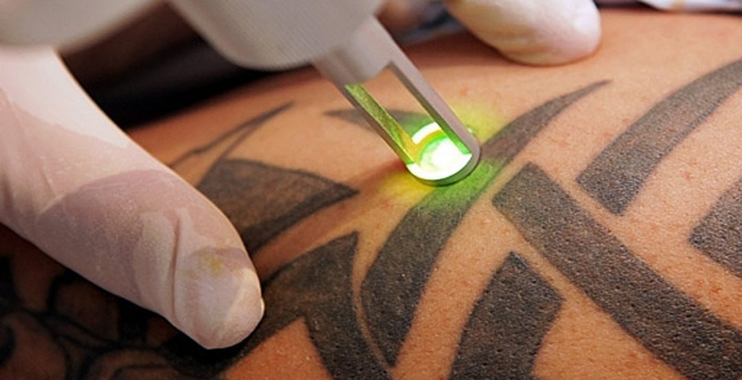 ¿Se puede volver a tatuar en el lugar de un tatuaje borrado y Es seguro tatuarse en el mismo lugar en donde eliminamos un tatuaje?