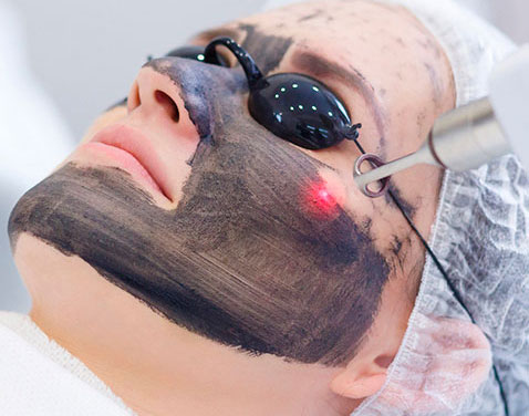 Hollywood Peeling (Peeling de Carbono con Laser de ND: YAG), Fototerapia Facial