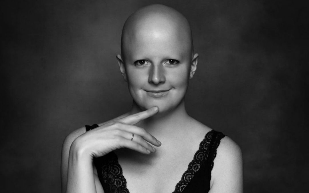 Alopecia areata Femenina. Un proceso de pérdida de cabello, hay que desculpabilizarlas y reducir el impacto emocional para que tengan calidad de vida.