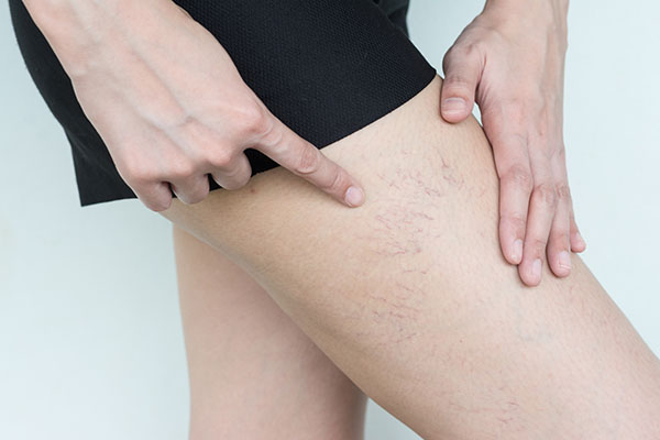 Laser; Longitudes de onda recomendadas para la eliminación de ARAÑAS VASCULARES en las piernas
