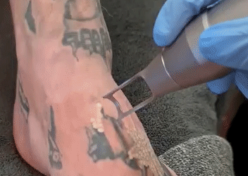 Como podemos calcular el precio y coste por disparo en un láser de eliminación de tatoo