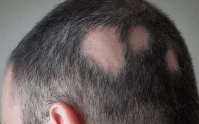 Baricitinib estimula/promueve el crecimiento del cabello en adultos con alopecia areata