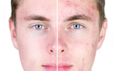 4 tecnologías / tratamientos para eliminar las cicatrices del acné: