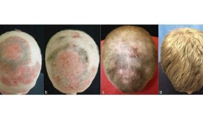 ¿El Fin de la Calvicie? Citrato de Tofacitinib: Una Solución Prometedora para el Tratamiento de la Alopecia Areata