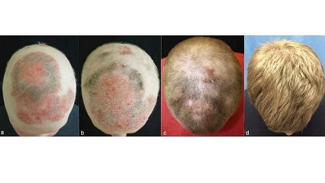 ¿El Fin de la Calvicie? Citrato de Tofacitinib: Una Solución Prometedora para el Tratamiento de la Alopecia Areata