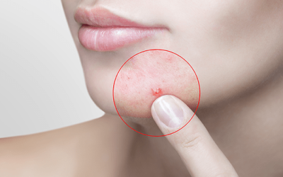 4 acné hormonal, ¿Cómo identificarlos?, ¿cómo combatirlos?