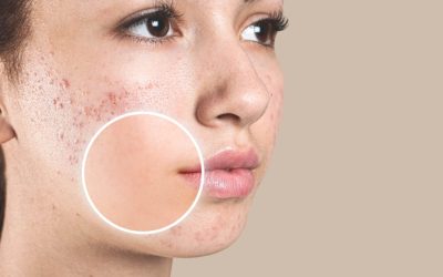 Láser y otras opciones para acabar con las Molestas cicatrices del acné