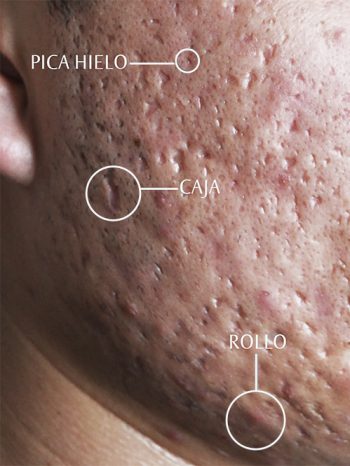 La importancia de identificar el tipo de cicatriz (macula) en el acné