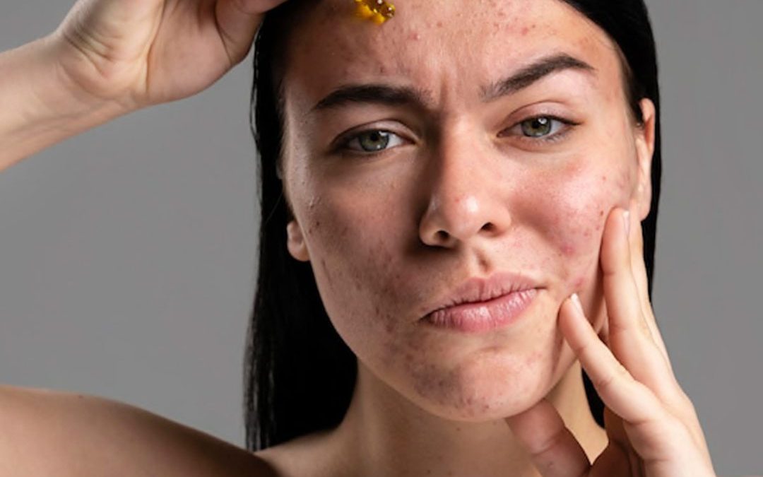4 Diferentes técnicas de láser para acabar con las molestas marcas – cicatrices del acné