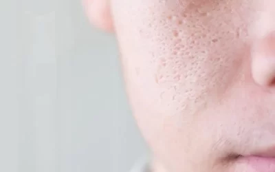 Rutina SkinCare para cerrar – eliminar los poros faciales